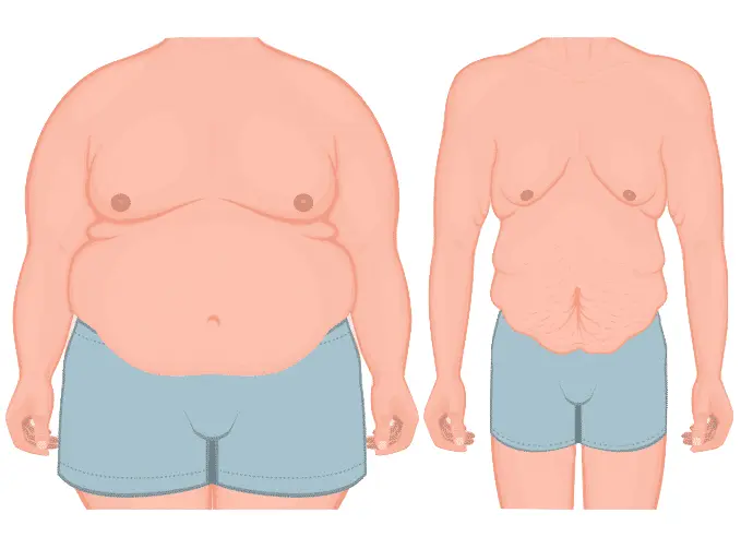 Chirurgie bariatrique ou jeûne intermittent ? Quelle méthode est la plus efficace pour maigrir ?
