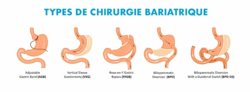 Chirurgie bariatrique ou jeûne intermittent ? Quelle méthode est la plus efficace pour maigrir ?