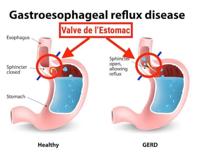 Quelles-sont-les-causes-des-remontées-acides-santé-dacier